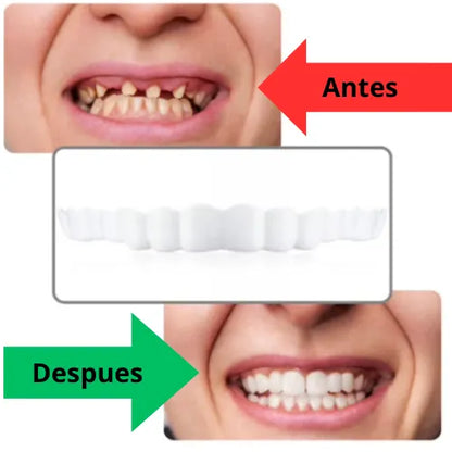 Sonrisa al Instante: Carillas dentales personalizadas